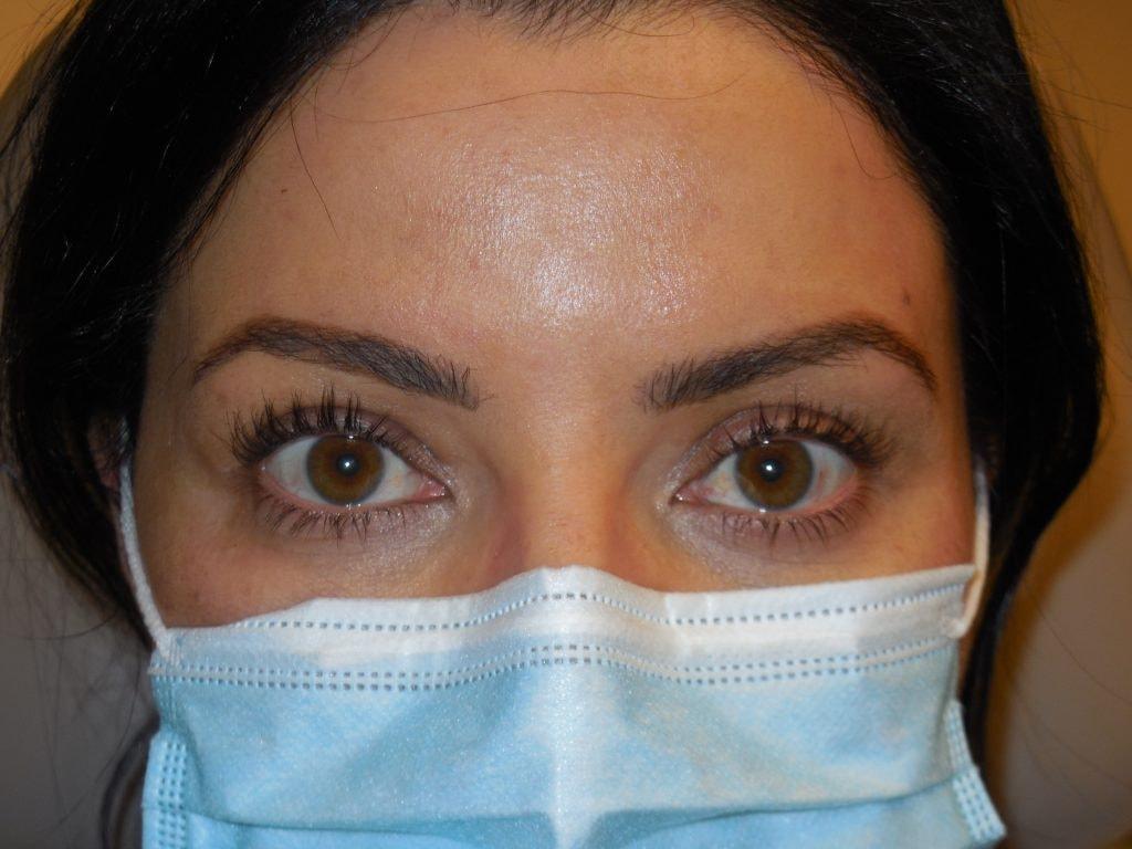 Cynthia M Goodman, MD eyelid lift after — Larkspur, CA