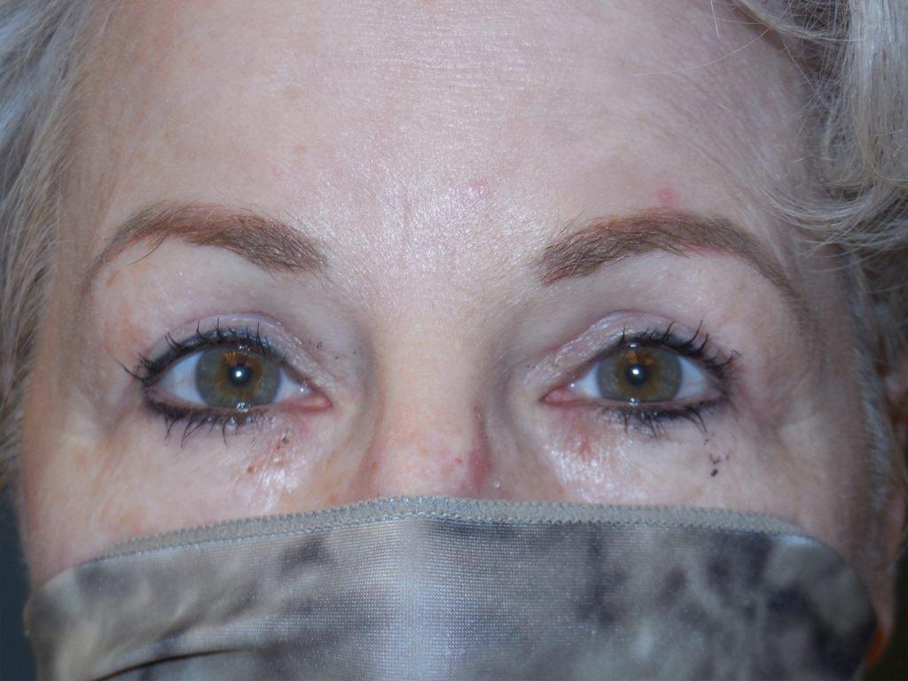 Cynthia M Goodman, MD eyelid lift after — Larkspur, CA