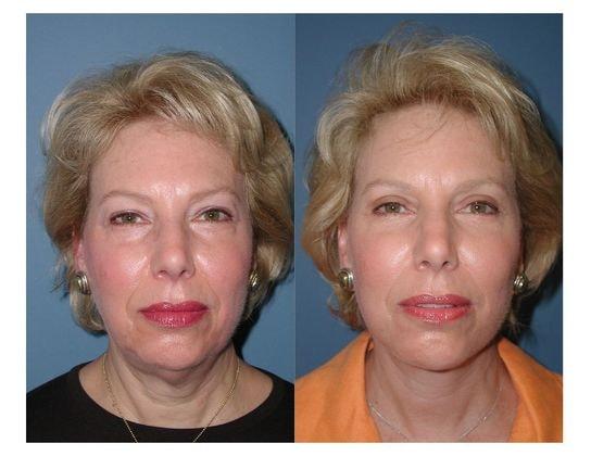Jon B. Turk, MD eyelid lift result — Woodbury, NY