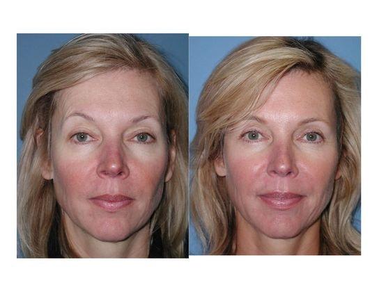 Jon B. Turk, MD eyelid lift result — Woodbury, NY