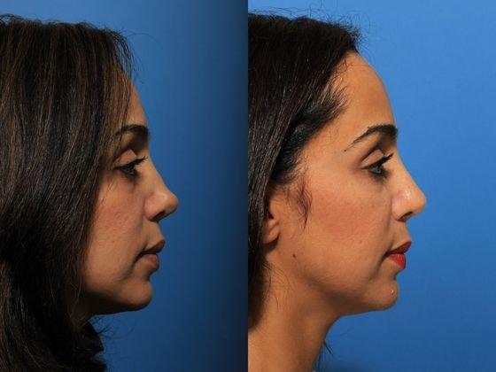 Jon B. Turk, MD rhinoplasty result — Woodbury, NY