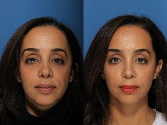 Jon B. Turk, MD rhinoplasty result — Woodbury, NY