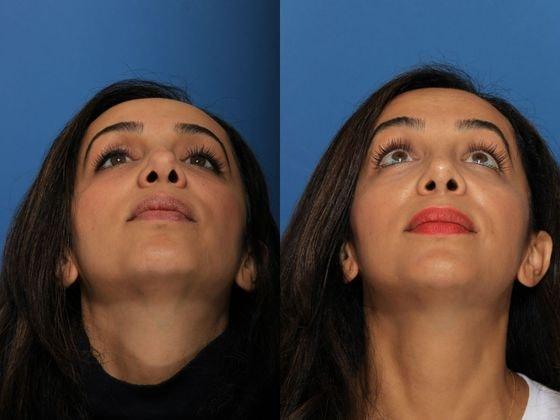 Jon B. Turk, MD rhinoplasty result — Woodbury, NY