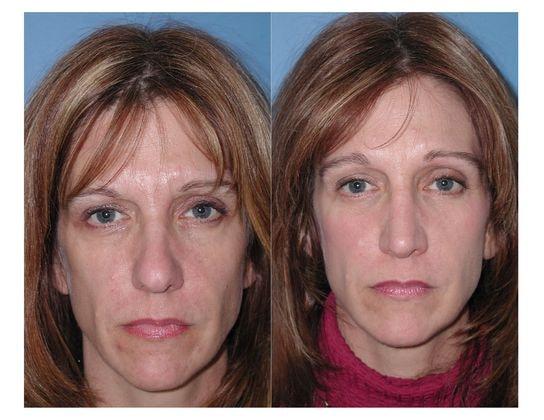 Jon B. Turk, MD brow lift result — Woodbury, NY