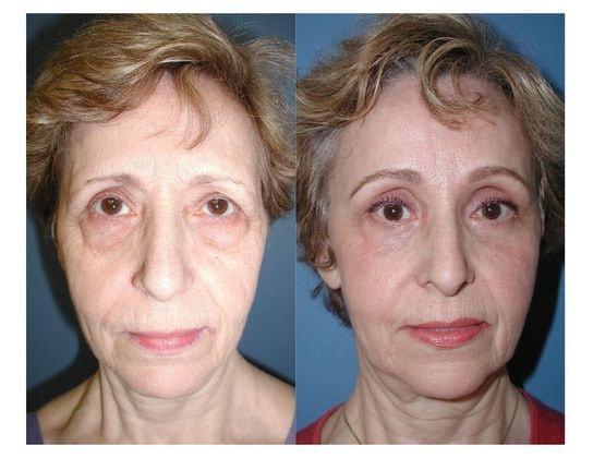Jon B. Turk, MD eyelid lift result — Woodbury, NY