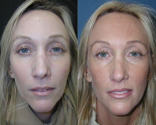 Jon B. Turk, MD eyelid lift result — Woodbury, NY