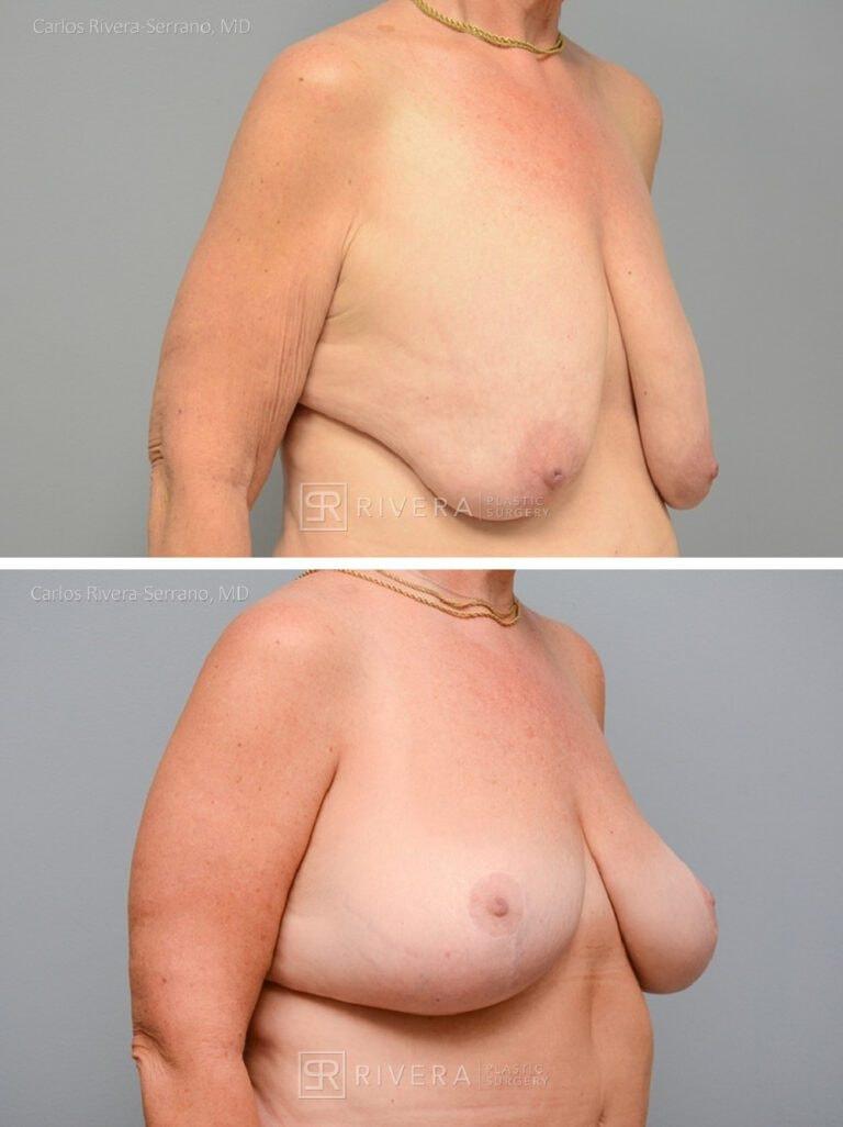 Rivera Plastic Surgery breast lift result — Miami Beach, FL