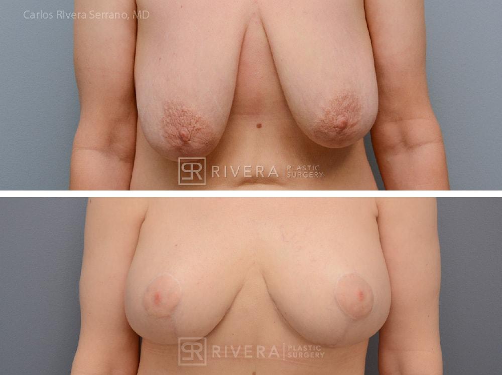 Rivera Plastic Surgery mommy makeover result — Miami Beach, FL