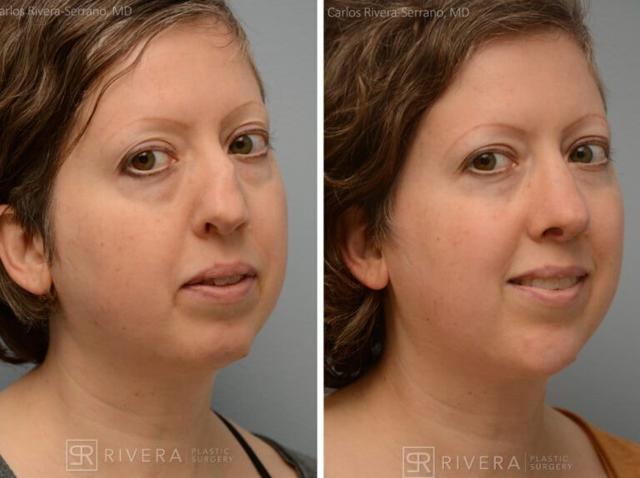 Functional Rhinoplasty result at Rivera Plastic Surgery in Miami Beach, FL