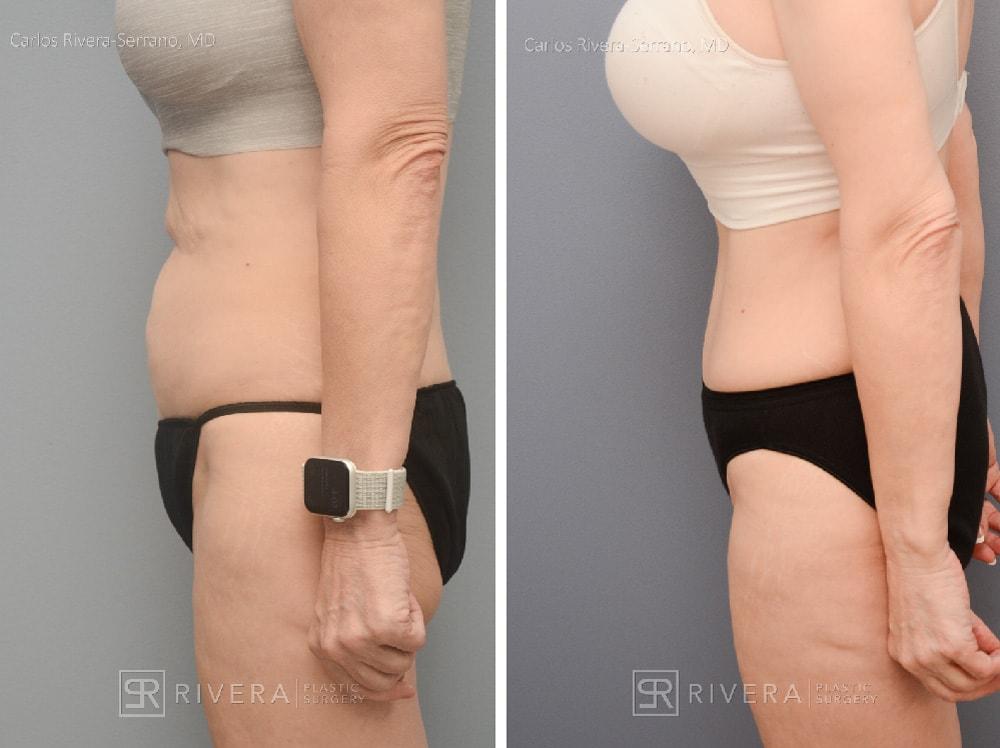 Rivera Plastic Surgery mommy makeover result — Miami Beach, FL