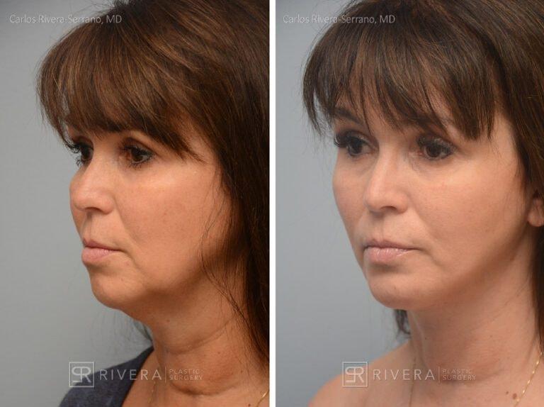 Rivera Plastic Surgery neck lift result — Miami Beach, FL