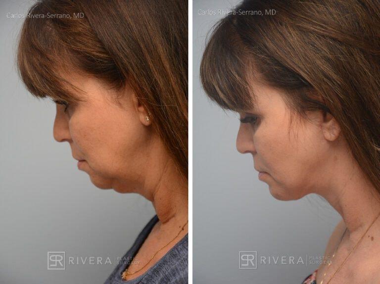 Rivera Plastic Surgery neck lift result — Miami Beach, FL