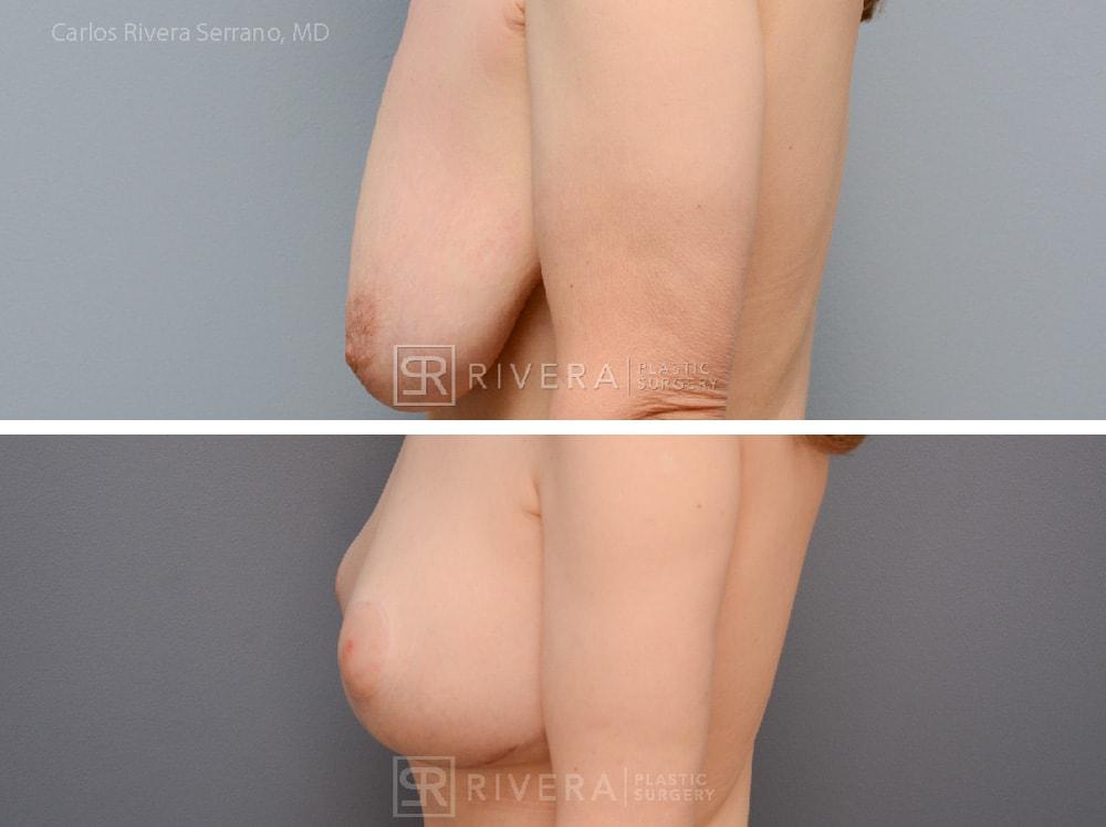 Rivera Plastic Surgery mommy makeover result — Miami Beach, FL