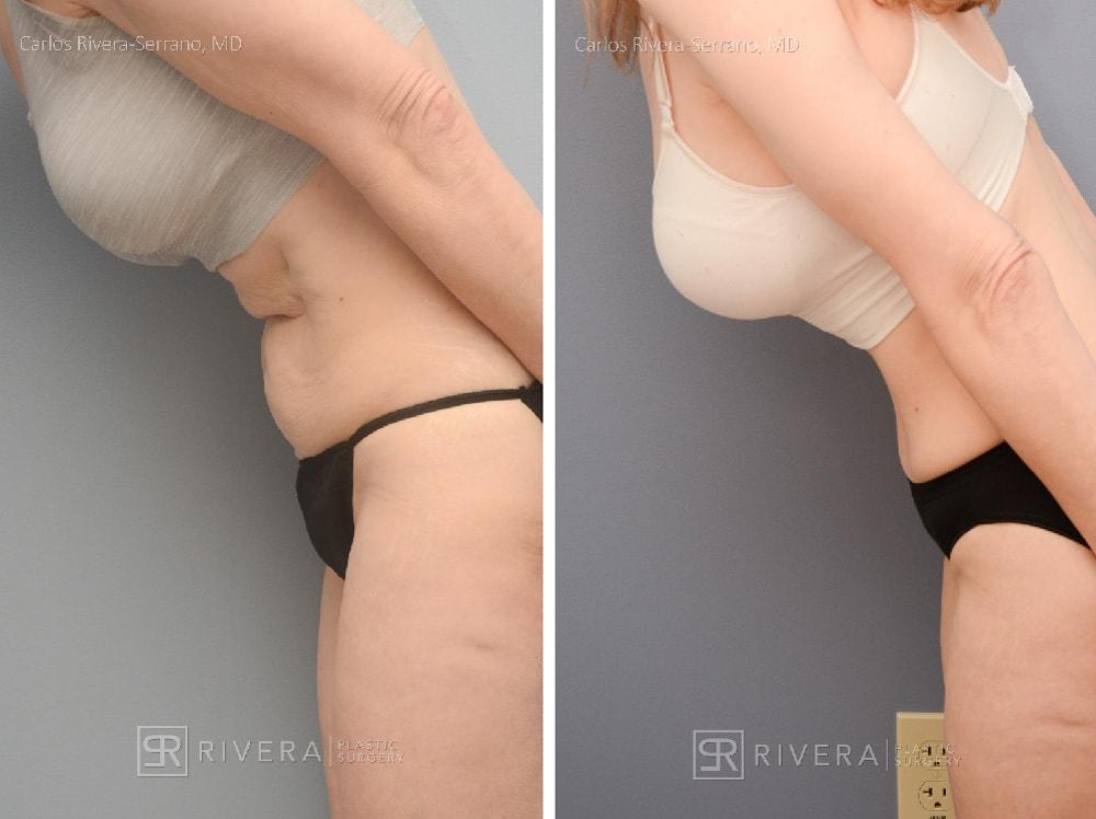 Rivera Plastic Surgery mommy makeover result — Miami Beach, FL
