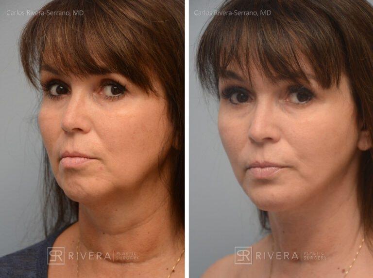 Rivera Plastic Surgery neck lift result — Miami Beach, FL