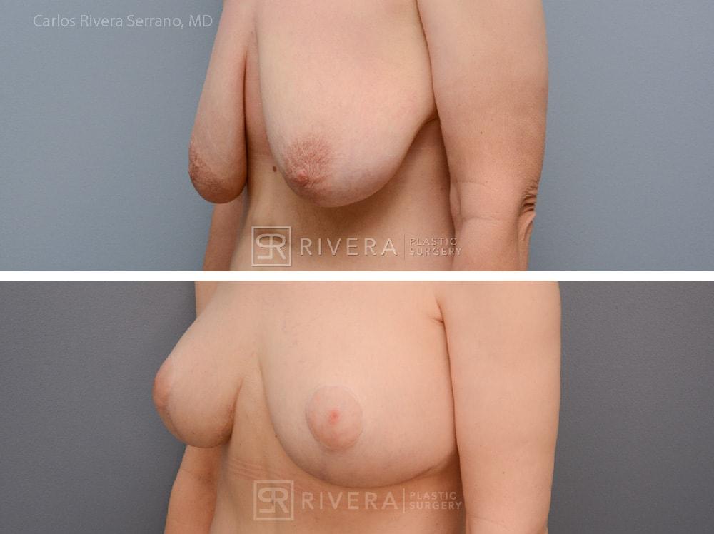 Rivera Plastic Surgery mommy makeover result — Miami Beach, FL