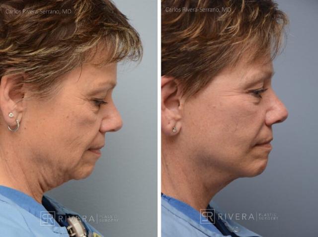Mini Facelift result at Rivera Plastic Surgery in Miami Beach, FL