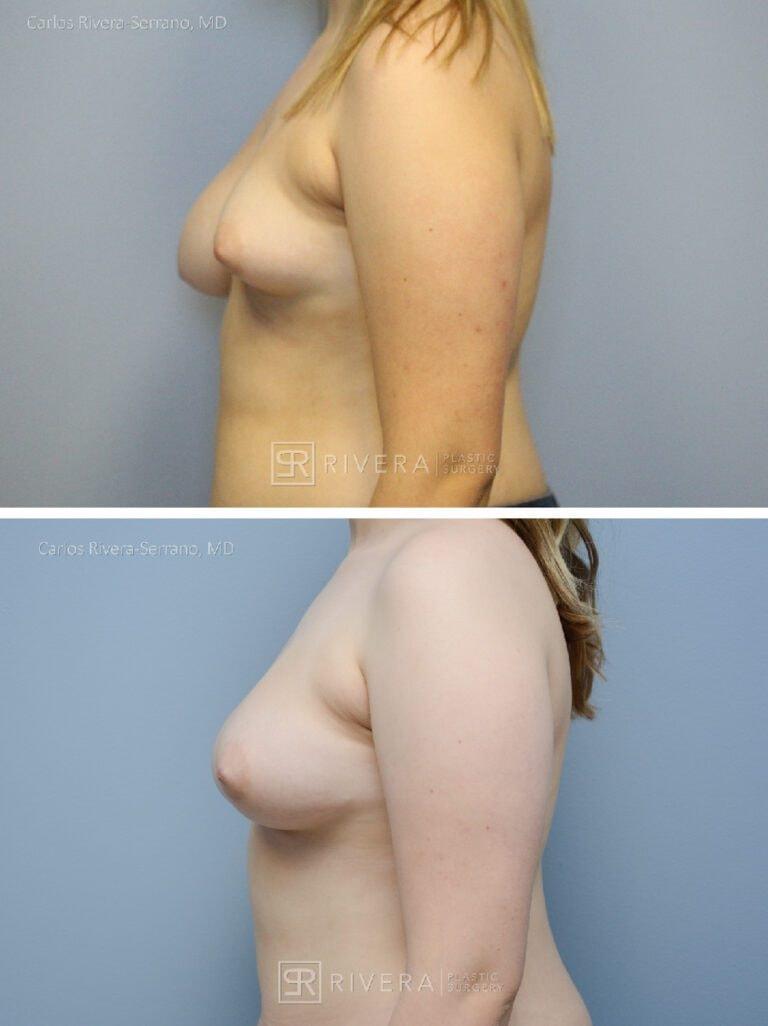 Rivera Plastic Surgery breast lift result — Miami Beach, FL