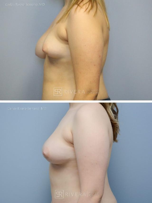 Breast Lift result at Rivera Plastic Surgery in Miami Beach, FL
