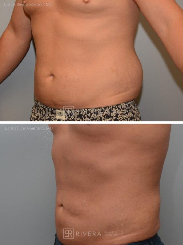 Liposuction result at Rivera Plastic Surgery in Miami Beach, FL