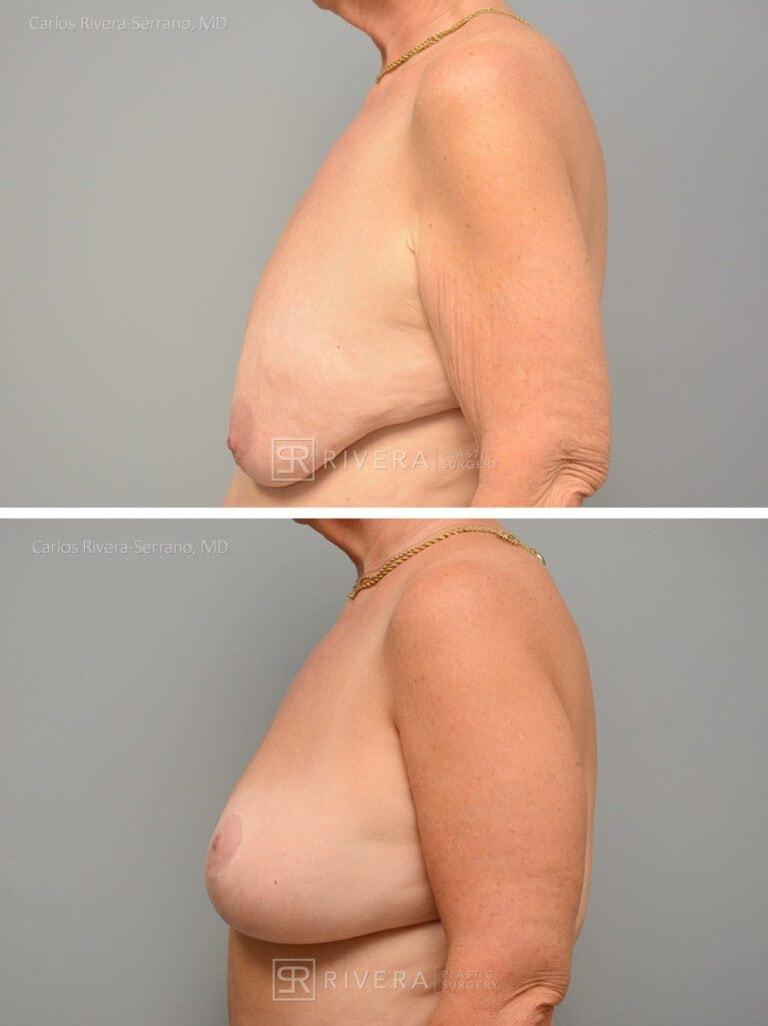 Rivera Plastic Surgery breast lift result — Miami Beach, FL