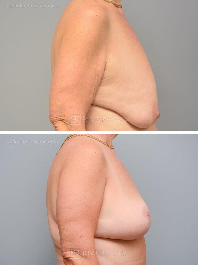 Rivera Plastic Surgery breast lift result — Miami Beach, FL