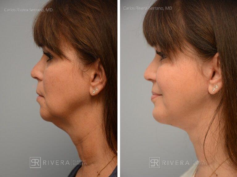 Rivera Plastic Surgery neck lift result — Miami Beach, FL