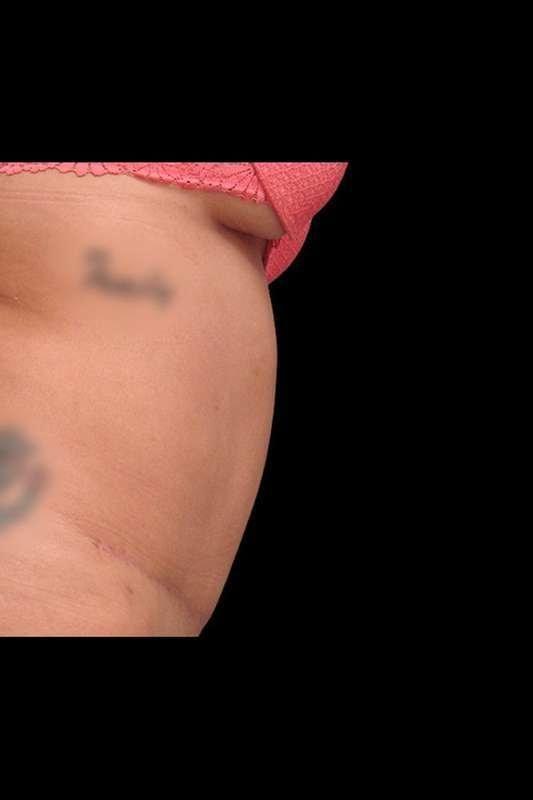 Ryan Couvillion, MD tummy tuck after — Houston, TX