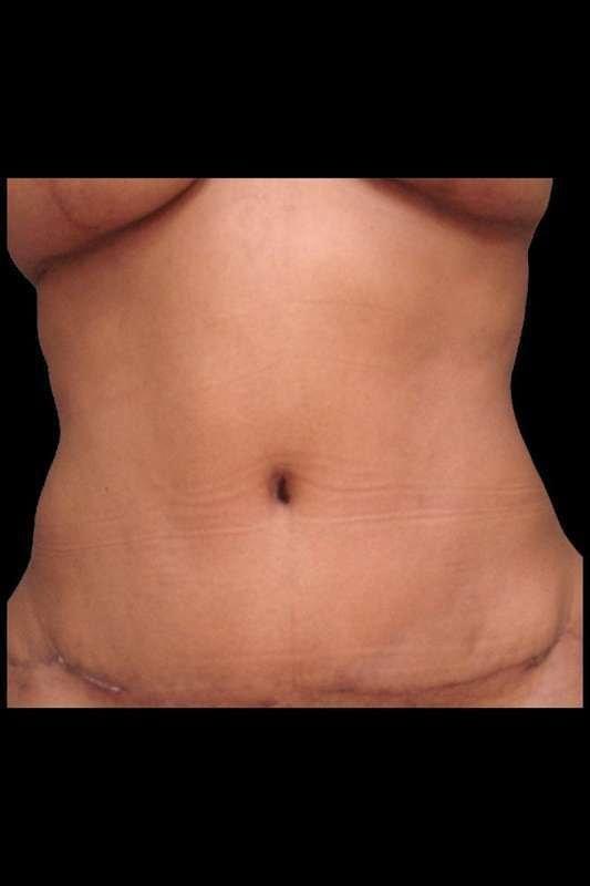 Ryan Couvillion, MD tummy tuck after — Houston, TX