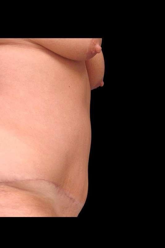 Ryan Couvillion, MD tummy tuck after — Houston, TX