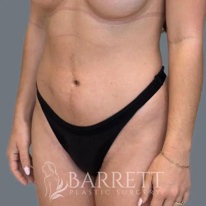 Barrett Plastic Surgery tummy tuck after — Beverly Hills, CA