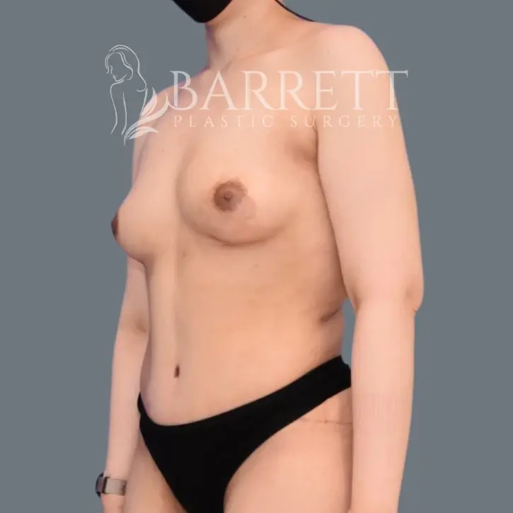 Barrett Plastic Surgery tummy tuck after — Beverly Hills, CA