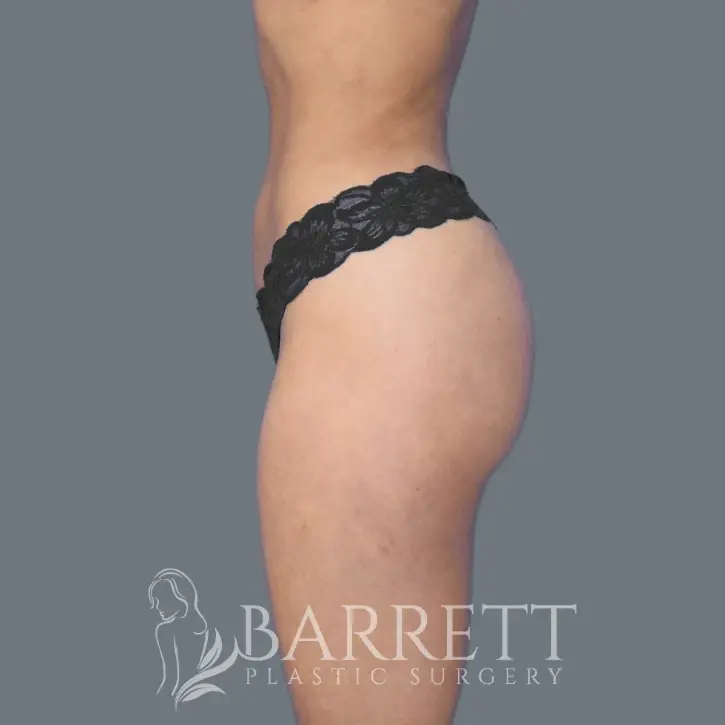 Barrett Plastic Surgery bbl after — Beverly Hills, CA