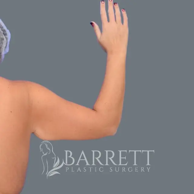Arm Lift before at Barrett Plastic Surgery in Beverly Hills, CA