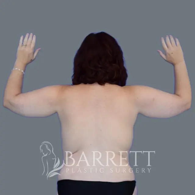 Arm Lift before at Barrett Plastic Surgery in Beverly Hills, CA