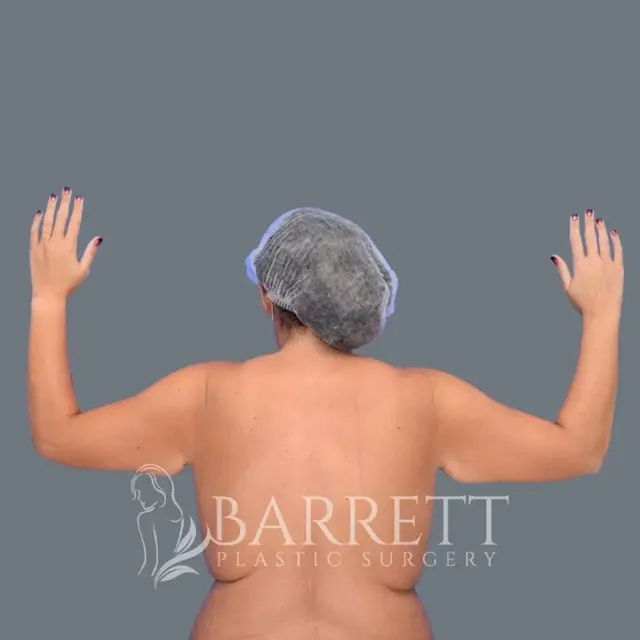 Arm Lift before at Barrett Plastic Surgery in Beverly Hills, CA