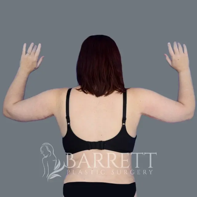 Arm Lift after at Barrett Plastic Surgery in Beverly Hills, CA