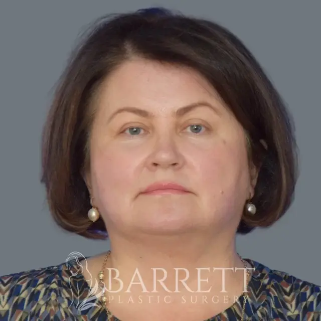 Laser Skin Resurfacing after at Barrett Plastic Surgery in Beverly Hills, CA