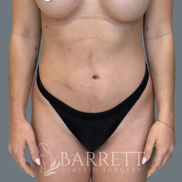 Barrett Plastic Surgery tummy tuck after — Beverly Hills, CA