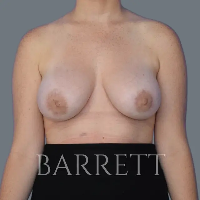 Breast Augmentation after at Barrett Plastic Surgery in Beverly Hills, CA