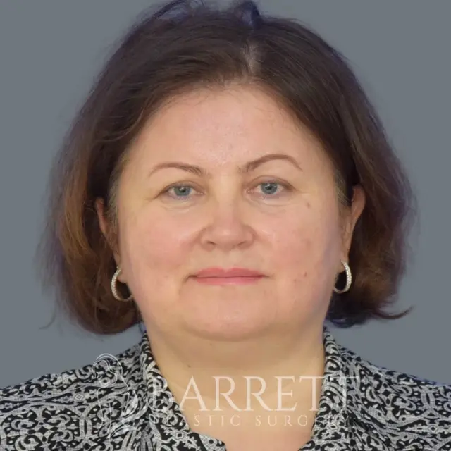 Laser Skin Resurfacing before at Barrett Plastic Surgery in Beverly Hills, CA