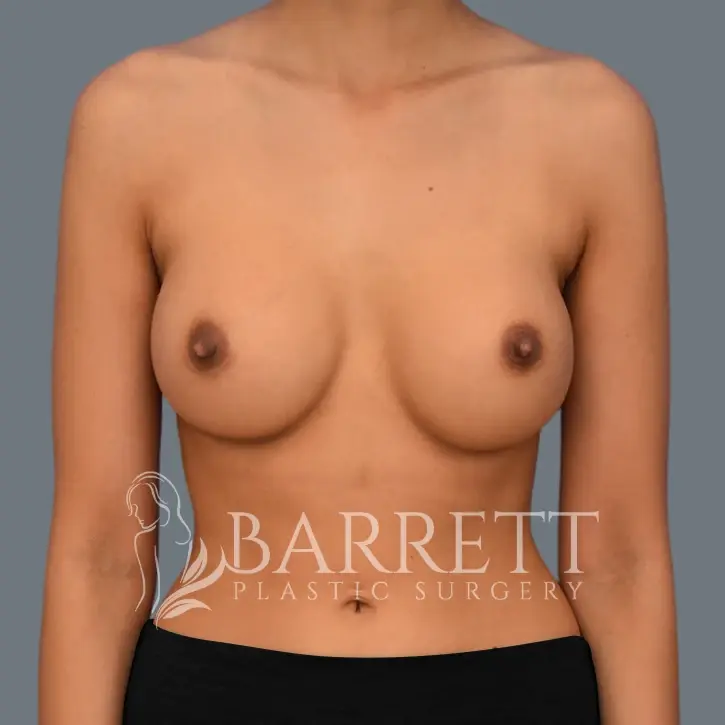 Barrett Plastic Surgery breast augmentation after — Beverly Hills, CA