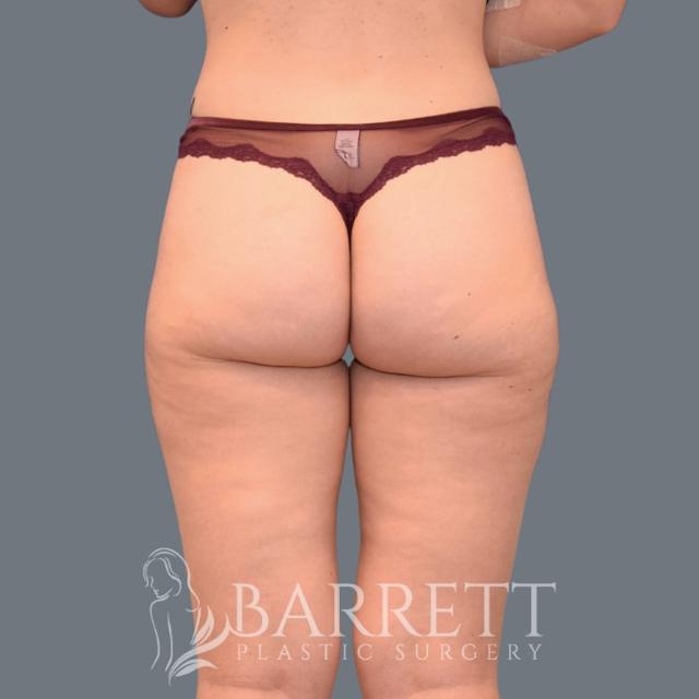 Brazilian Butt Lift before at Barrett Plastic Surgery in Beverly Hills, CA