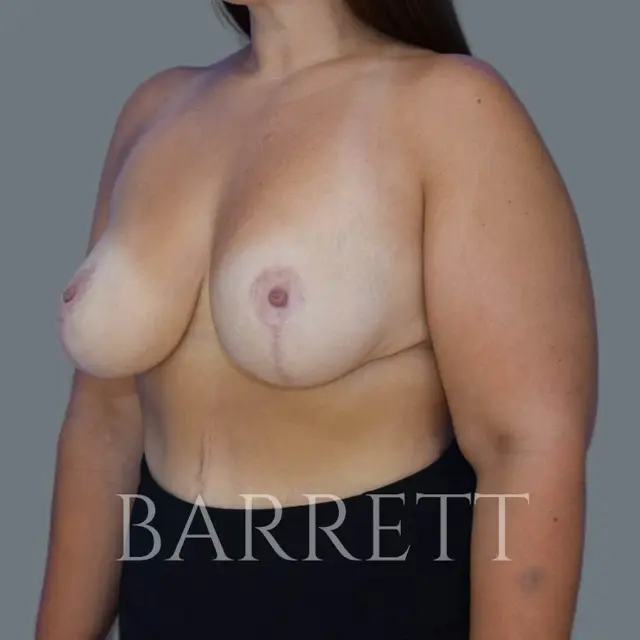 Breast Reduction after at Barrett Plastic Surgery in Beverly Hills, CA