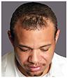Bosley – Hair Restoration & Transplant – Salt Lake City (Sandy) result — Sandy, UT