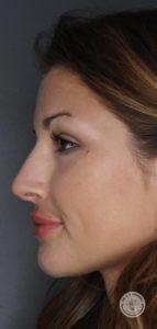 Rhinoplasty after at Dr. J. J. Wendel Plastic Surgery in Nashville, TN