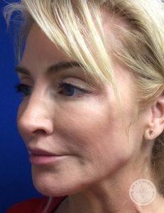Deep Plane Facelift after at Dr. J. J. Wendel Plastic Surgery in Nashville, TN