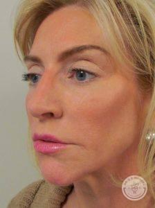 Deep Plane Facelift before at Dr. J. J. Wendel Plastic Surgery in Nashville, TN
