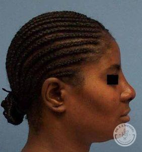 Rhinoplasty after at Dr. J. J. Wendel Plastic Surgery in Nashville, TN