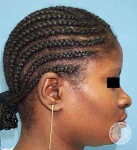 Rhinoplasty before at Dr. J. J. Wendel Plastic Surgery in Nashville, TN